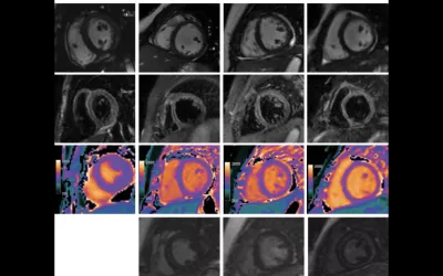 Cardiac MRI scans in four children with acute myocarditis from Multisystem Inflammatory Syndrome in Children (MIS-C) caused by COVID-19. Top panel demonstrates minimal pericardial effusion on cine images. Second panel demonstrates increased T2 short tau inversion-recovery signal intensity with average ratios between myocardium and muscle greater than 2 in patient 2 (12-year-old boy), patient 3 (11-year-old girl), and patient 4 (6-year-old girl). MRI of COVID. What does COVID look like in the heart?