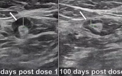 Left, transverse image of left axilla on initial breast ultrasound, 19 days after first dose of Pfizer COVID-19 vaccination to left upper extremity in a 37-year-old women who came in for bilateral screening breast ultrasound. Right, follow-up ultrasound, 100 days after first COVID-19 vaccine dose, demonstrates cortical thickness of 2 mm (arrow), consistent with resolution of left axillary lymphadenopathy (arrow). AJR. What does lymphadenopathy look like? COVID vaccine caused swollen lymph nodes.