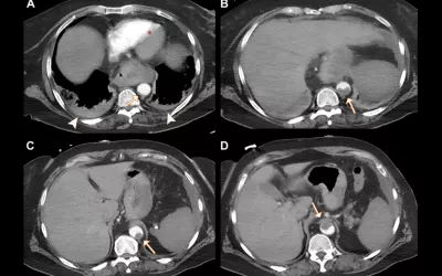 COVID causes an increased risk of clotting. Example of an aortic mural clot (arrows) on contrast-enhanced CT scans in a 63-year-old woman with COVID-19 and a history of antiphospholipid syndrome. Image courtesy of RSNA. Image of COVID thrombosis clotting in aorta.