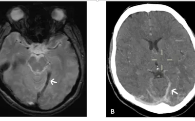 A 28-year-old woman who presented with headache and subsequent collapse. Cerebral venous sinus thrombosis was diagnosed and whole-body imaging demonstrated large volume splanchnic vein thrombosis. (A) Susceptibility weighted axial brain MRI showing a thrombosed internal cerebral vein branch leading to the straight sinus (arrow). (B) Unenhanced axial head CT showing hyperattenuating clot within the cortical vein and transverse sinuses (arrow). Images courtesy of RSNA. Read more