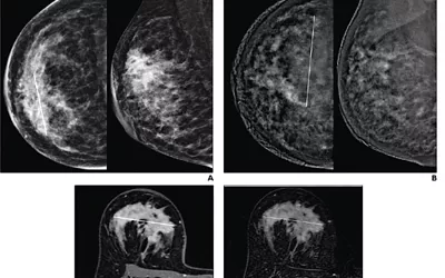 Mammography vs. breast MRI from a 41-year-old woman with invasive ductal carcinoma (G2, luminal B) of right breast. (A) CC (left) and MLO (right) low-energy images from pre-NAT CEM performed on 25th day of luteal phase show a 60 mm architectural distortion (line on CC) in the central portion of the right breast. (B) CC (left) and MLO (right) recombined images from pre-NAT CEM show marked background parenchymal enhancement, hindering lesion evaluation. MRI vs mammography imaging.
