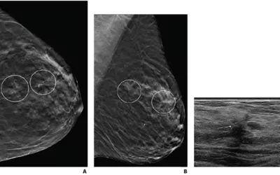 Single vs. multiple architectural distortion on digital breast tomosynthesis (DBT). (A) Craniocaudal, and (B) mediolateral oblique digital breast tomosynthesis images demonstrate two areas of AD in upper outer left breast (circles) that persisted on additional diagnostic tomosynthesis images. C is a comparison on breast ultrasound. AJR photo. What does architectural distortion on a mammogram?