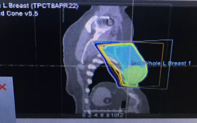Example of an external radiation therapy treatment plan for a 73-year-old woman who had a small ductal carcinoma in situ (DCIS) surgically removed. The post-operative LINAC radiotherapy is to eliminate any cancer cells that may have been left behind from the surgery. Image courtesy of the the patient. What is breast radiation therapy? Radiotherapy for DCIS.