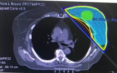 Example of an external radiation therapy treatment plan for a 73-year-old woman who had a small ductal carcinoma in situ (DCIS) surgically removed. The post-operative LINAC radiotherapy is to eliminate any cancer cells that may have been left behind from the surgery. Image courtesy of the the patient. What is breast radiation therapy? Radiotherapy for DCIS. What is post operative breast radiotherapy?