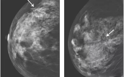 Architectural distortion seen in the breast of a 67-year-old woman who presented for screening mammography. Surgical pathology revealed invasive ductal adenocarcinoma. Image from AJR