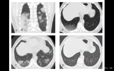 High resolution non-contrast chest CT findings in a 72-yr-old man with COVID-19 pneumonia over a 1-year follow-up. (A) Baseline axial section shows extensive hazy GGO with dark bronchogram signs in the lower lung lobes (lung severity score of 12/20). (B) Incomplete recovery of GGO areas and the presence of reticulation and multiple medullary traction bronchiectasis/bronchiolectasis (black arrows) with “corkscrew” features suggestive of architectural fibrotic distortion. What does COVID look like on CT? 