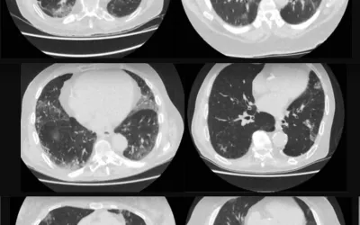 In the spring of 2020 as the pandemic spread around the world, radiology developed the COVID-19 Reporting and Data System (CO-RADS) to standardize assessment of pulmonary involvement of COVID-19 on unenhanced chest CT images. The scoring system also was designed to standardize reports and help increase interobserver agreement. This image shows the the more severe categories. Top, CO-RADS 3, middle CO-RADS 4 and bottom CO-RADS 5. The COVID pneumonia appears as foggy lighter areas. Examples of CO-RADS images.