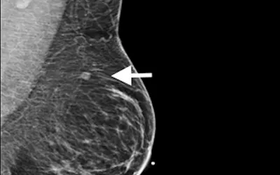The COVID vaccines were found in early 2020 shortly after they were released they can cause immune response that mimics cancer on mammograms. Image in 37-year-old woman with palpable adenopathy (swollen lymph node). Mammogram of left breast shows prominent left axillary adenopathy and intramammary lymph node (arrows). LMLO = left medio-lateral oblique. She received her first dose of the Moderna COVID-19 vaccine 12 days before the mammogram in the left arm. Image RSNA. Covid vaccine cause adenapathy.