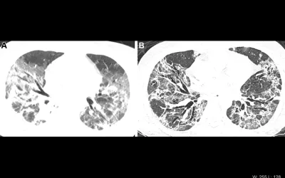Patient with severe, lung damage from COVID. Images in a 54-year-old man with COVID-19–related acute respiratory distress syndrome and subsequent fibrosis. (A) Axial CT 2 weeks after admission shows diffuse ground-glass opacity (GGO) with reticular abnormality and traction bronchiectasis in right middle lobe, indicating organizing phase of lung injury. (B) Axial CT 6 months after admission shows decreased GGO but extensive traction bronchiectasis and architectural distortion, suggesting fibrosis. RSNA