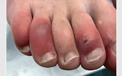 While less common, the coronavirus can affect your skin. For some people, this may be the only sign of a coronavirus infection. Patients who test positive for the coronavirus can develop discolored and swollen toes that turn red or purple. Image courtesy of the American Academy of Dermatology. What is COVID toe? What does COVID toe look like? Clinical imaging presentations of COVID. Clinical images of COVID. Medical imaging of COVID-19, SARS-CoV-2. What dose COVID look like on medical imaging?