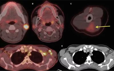 Top right image shows injection site. A 32-year-old woman, A, axial fused 18F-FDG PET/CT shows hypermetabolic biopsy-proven intraparotid lymph node with metastatic malignant melanoma. B, Three-month follow-up axial fused 18F-FDG PET/CT shows complete resolution of neck mass following chemotherapy, while, C, left arm shows hypermetabolic triangular-shaped inflammation (arrow) at COVID-19 vaccine injection site. D, Axial fused images at axilla level shows multiple new hypermetabolic lymph nodes. RSNA image