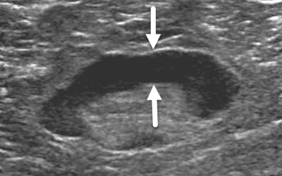 Breast ultrasound of a 62-year-old woman with benign reactive adenopathy after COVID-19 vaccination. The vaccine can cause a nature immune response reaction in the lymph nodes near the injection site that can last 1-10 weeks but is benign. However, it can mimic a breast cancer cancer response and may raise alarm on the exams of recently vaccinated or boosted patients. Image from Academic Radiology.