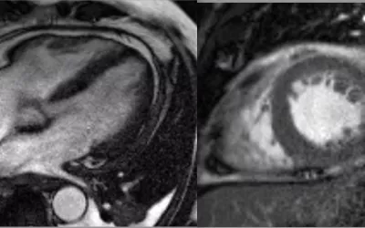 Cardiac MRI showing pericarditis from COVID in a 52-year-old male. Four chamber view demonstrating low normal biventricular systolic function and marked pericardial thickening with moderate left pleural effusion. Short axis image demonstrating low normal biventricular systolic function and marked pericardial thickening. Image from SCMR. Covid pericarditis. CT of COVID. What does COVID look like in the lungs? Images of COVID clinical presentations. What does COVID look like in the heart?
