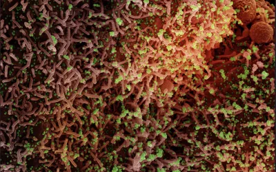 Colorized scanning electron micrograph of a cell infected with a variant strain of SARS-CoV-2 virus particles (green), isolated from a patient sample. Image captured at the NIAID Integrated Research Facility (IRF) in Fort Detrick, Maryland. Credit: NIAID What does COVID look like under a microscope? Images of COVID clinical presentations. What does COVID look like under a microscope?