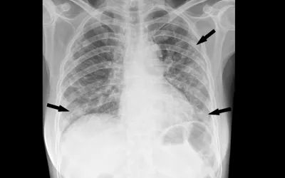 Chest radiograph in a 53-year-old woman with confirmed coronavirus disease 2019, or COVID-19, pneumonia. The patient had fever and cough for 5 days. Multifocal patchy opacities (arrows) can be seen in both lungs. Imaghe from among the first Chinese infected with COVID to be imaged in January 2020. Image courtesy of RSNA. What COVID looks like ob CT medical imaging.
