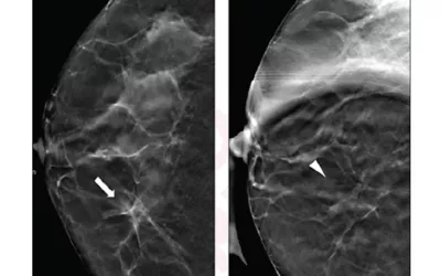 A 52-year-old woman presenting for asymmetry of right breast and showing how spot commission can help. (A) Digital breast tomosynthesis (DBT) craniocaudal view shows asymmetry (arrow) in medial right breast. (B) DBT spot compression view shows asymmetry does not persist (arrowhead). Lesion classified on DBT without, and DBT with, DBT spot compression view as BI-RADS category 4a. Follow-up imaging at one year demonstrated stability of finding, consistent with benignity in present analysis. AJR image