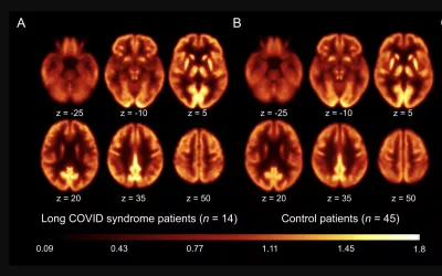 Brain 18F-FDG PET imaging of patients with long-COVID syndrome and control patients, showing no significant differences. The molecular imaging suggests long-COVID symptoms may be caused by fatigue, not regional brain dysfunction. A and B: Transaxial sections of group averaged, spatially normalized 18F-FDG PET scans in patients with long-COVID syndrome (A) and control patients (B). Image courtesy of SNMMI. Clinical imaging presentations of COVID. Clinical images of COVID. Medical imaging of long-COVID.