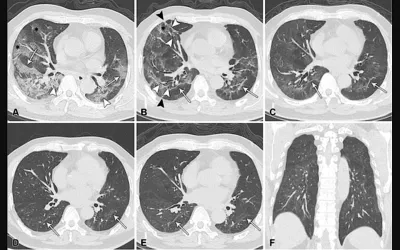 Serial CT scans of a 64-year-old man, who progressed to acute respiratory distress syndrome caused by COVID-19. It shows typical findings over time for participants with residual linear opacities in the lungs. Clinical imaging presentations of COVID. Clinical images of COVID. Medical imaging of COVID-19, SARS-CoV-2. #COVID 