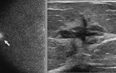 75-year-old woman with a palpable abnormality in the right breast and abnormal diagnostic mammography and ultrasound. Molecular breast imaging (MBI) was performed before biopsy. Left, right craniocaudal (CC) image from a dual-detector MBI examination shows a mass with marked intensity of uptake in the right breast at 12 o’clock, anterior depth (arrow), clinically assessed as suspicious for malignancy (category 4). Right, breast ultrasound shows an irregular hypoechoic mass with spiculated margins. AJR Image