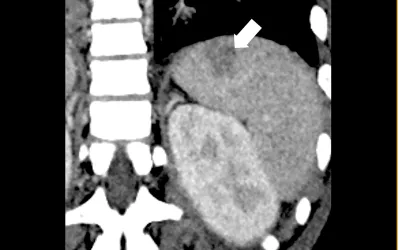 An infarct in the spleen in Multisystem Inflammatory Syndrome in Children (MIS-C) in a 15-year-old patient. Coronal CT image through the left upper quadrant shows a focal subcapsular, hypo-attenuating region within the spleen in keeping with a splenic infarct (arrow).Image courtesy of RSNA. COVID-caused MIS-C imaging.