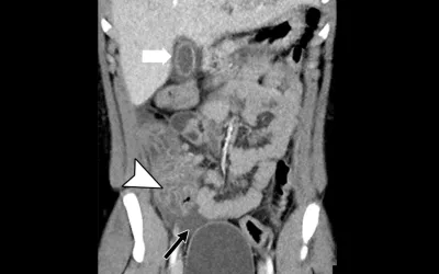 Multisystem Inflammatory Syndrome in Children (MIS-C) presentations on a contrast CT of the abdomen and pelvis in a 15-year-old boy. Coronal image of the abdomen demonstrates gallbladder wall edema (white arrow). There is extensive thickening of the cecal wall thickening (arrowhead) and free fluid within the pelvis (black arrow). Image courtesy of RSNA. Imaging MIS-C.