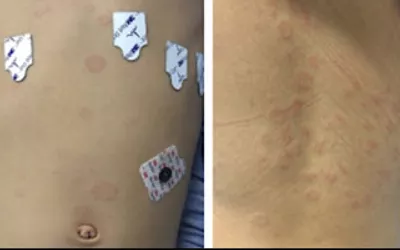 Rash caused by hyperinflammation caused by the post-infectious complication of COVID infection, multi-system inflammatory syndrome in children (MIS-C). Annular plaques on the torso (L) and back (R) of a patient with MIS-C. The syndrome effects a very small percentage of pediatric patients infected with COVID, including those who had completely asymptomatic infections. What does MIS-C look like? Children’s Hospital of Philadelphia. What does COVID look like? Images of COVID clinical presentations.