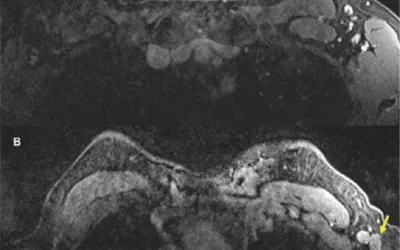 In a 57-year-old woman, A, axial contrast-enhanced fat-saturated T1 sequence of MRI from a year earlier shows subcentimeter benign lymph nodes in left axilla. B, Most recent contrast-enhanced axial fat-saturated T1 sequence at approximately same level shows multiple new enlarged lymph nodes (arrows) in left axilla. There were no other suspicious findings to suggest primary breast cancer. Image courtesy of RSNA. What does a breast MRI look like?