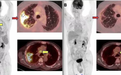 A 71-year-old male was diagnosed with COVID-19 in October 2020. He was treated and discharged from the hospital. He was readmitted to the hospital for respiratory failure in January 2021. He underwent 18F-FDG PET/CT. patient was given steroids and Pirfenidone for two months. SNMMI image. COVID on nuclear scan. Clinical imaging presentations of COVID. Clinical images of COVID. Medical imaging of COVID-19, SARS-CoV-2. What dose COVID look like on medical imaging?