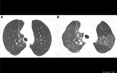 Respiratory complication following COVID. Images demonstrate obstructive lung disease after COVID-19 in a 60-year-old woman. (A) Axial inspiratory CT with persistent shortness of breath and chest tightness 8 months following COVID-19 infection shows subtle mosaic attenuation, best seen in anterior left upper lobe. (B) Axial expiratory CT confirms lobular air trapping, which was present on multiple images, indicating small airway obstruction. Image courtesy of RSNA. What is COVID obstructive lung disease?