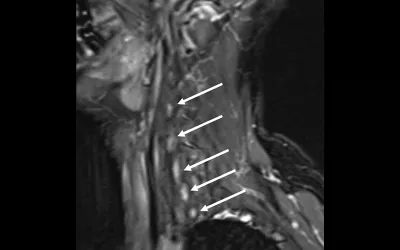 Neck MRI neurography showing nerve damage from Parsonage-Turner syndrome from suspected COVID. The 58-year-old woman had sudden-onset severe right upper extremity pain and weakness. Had two episodes of respiratory viral infection in month preceding onset of symptoms (COVID testing not performed). Clinical suspicion was for Parsonage-Turner syndrome and MR neurography of brachial plexus was performed. Clinical imaging presentations of COVID. Clinical images of COVID. Medical imaging of COVID-19, SARS-CoV-2. 