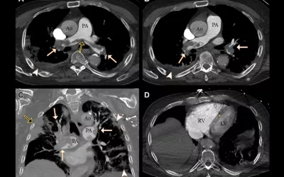 COVID causes increase risk of clotting. Example of a pulmonary embolism. CT pulmonary angiograms in a 77-year-old man with COVID-19 and a saddle embolus to pulmonary arteries (black arrow in A) extending into right and left pulmonary arteries (white arrows) in (A, B) axial and (C) coronal planes. Arrowheads show pulmonary changes associated with COVID-19 and possible lung infarction (black arrow in C). (D) Axial image at the level of the ventricles shows right-sided heart strain. RSNA. COVID PE. CT of COVID