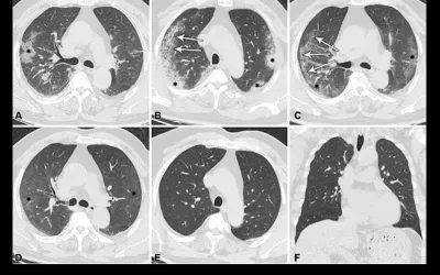 CT scans in a 60-year-old man diagnosed with COVID-19 pneumonia show typical CT findings over time for participants with complete resolution after 12 months. RSNA image. What does COVID look like on CT scans? How long does COVID stay in the lungs? Clinical imaging presentations of COVID. Clinical images of COVID. Medical imaging of COVID-19, SARS-CoV-2. What dose COVID look like on medical imaging?