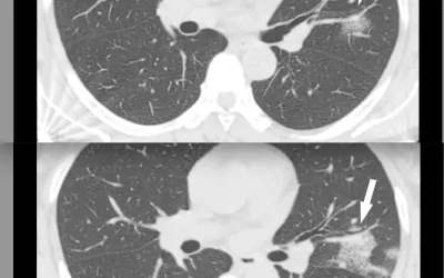 CT of coronavirus pneumonia, a solitary rounded ground-glass opacity (GGO) pattern. A 51-year-old woman in China presented in January 2020 without fever, but had close contact with positive patients. Top, baseline axial unenhanced chest CT obtained 6 days before the first positive PCR test. Bottom, chest CT scan 4 days later shows the size increase of the lesion (arrow). Image courtesy of RSNA. #COVID #SARSCoV2