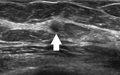 Targeted ultrasound of the left breast confirmed a 5 mm irregular hypoechoic mass_AJR.png