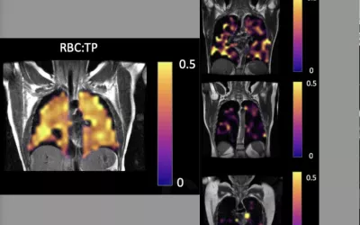 Comparison of a normal, healthy patient's lung gas exchange capacity (left) compared to three previously hospitalized COVID patients (right) who still stay they have problems breathing, despite having normal looking CT scans. Hyperpolarized xenon-129 gas MRI imaging shows shows significantly impaired gas transfer in the lungs of the recovered COVID patients. Image courtesy of RSNA. COVID damage to lungs not visible on CT scans. Clinical imaging presentations of COVID. What does COVID look like?