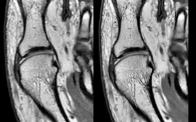 Example of an AI image reconstruction algorithm for MRI that can enhance image quality, reduce or eliminate noise and ringing artifact and help reduce scan times. This is the Air Recon Deep Learning Knee algorithm now used on GE Healthcare MRS scanners. It was cleared by the FDA in June 2022.