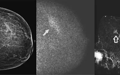 39-year-old woman with an abnormal baseline screening mammography result. Molecular breast imaging (MBI) was performed for problem-solving. Left, diagnostic mammography shows asymmetry in the outer left breast, middle depth (circle). Middle, molecular breast imaging (MBI) shows a segmental area of nonmass uptake with mild intensity in the outer left breast, middle depth (arrow), that corresponds with the mammographic asymmetry. Right, breast MRI. AJR Image