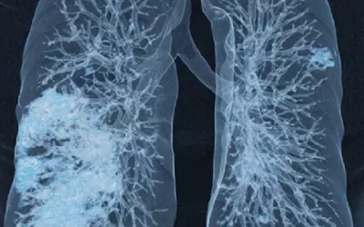 A lung CT 3D rendering showing patches of ground-glass lesions caused by COVID pneumonia. Image from Siemens