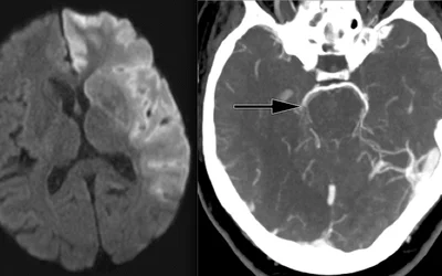 Ischemic stroke shown in CT scans. Image courtesy of RSNA