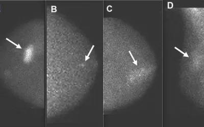 Images from molecular breast imaging (MBI) examinations demonstrating MBI lexicon descriptors. A, Mass (arrow) with marked intensity of uptake. B, Nonmass uptake (arrow) with focal distribution and mild intensity of uptake. C, Nonmass uptake (arrow) with segmental distribution and moderate intensity of uptake. D, Nonmass uptake (arrow) with regional distribution and mild intensity of uptake. Images courtesy of AJR. 