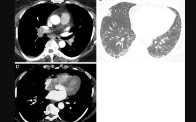 Images depict pulmonary vascular disease after COVID-19 with blood clotting in the lungs. in a 63-year-old woman with persistent shortness of breath and elevated D-dimer level. (A) Axial CT pulmonary arteriogram with persistent shortness of breath and elevated D-dimer level, 7 weeks after onset of infection, shows obstructive thrombus in right interlobar pulmonary artery. RSNA image. CT of COVID. What does COVID look like in the lungs? Images of COVID clinical presentations. What does COVID look like?