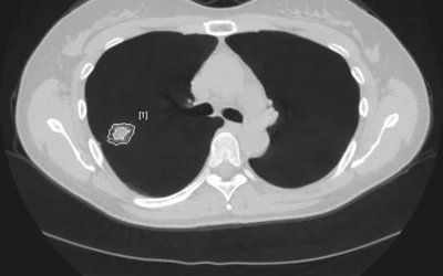 Example of pulmonary vessel suppression AI in a chest CT to help radiologists better identify and assess lung nodules using the Riverain ClearRead CT, which was cleared in September 2016. The AI to suppress the vessels was cleared based on the predicated Riverain DeltaView AI for bone suppression in chest X-rays, which was cleared by the FDA in December 2011.