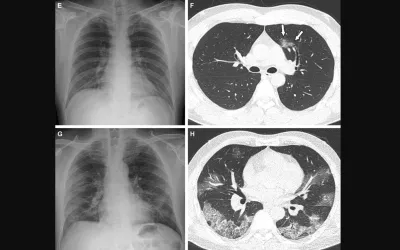 Representative cases showing pneumonia extents and patterns on chest X-ray (CXRs) and CT images in unvaccinated patients showing more severe disease. (E and F) A 36-year-old male with no history of vaccination for COVID- 19. Axial chest CT image obtained on the same day showing unilateral ground-glass opacity with a nonrounded morphology and non-peripheral distribution in the left upper lobe (arrows). RSNA Image. COVID on X-ray. What does COVID look like in medical imaging? Example of COVID imaging.