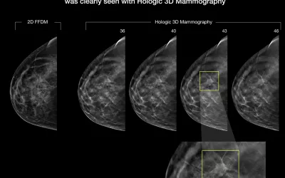 A comparison between 2D and 3D mammography on the Hologic Selenia Dimensions Mammography System. 3D tomosynthesis shoots a series of images of the breast can can be flipped through as slices of specific layers of the breast tissue, where 2D shows all the breast tissue in one image. Dense breast tissue can hide cancers, as can be seen here where one of the 3D slices found a cancer masked by dense tissue on the 2D image. Why is 3D mammography better? What is breast tomosythesis?