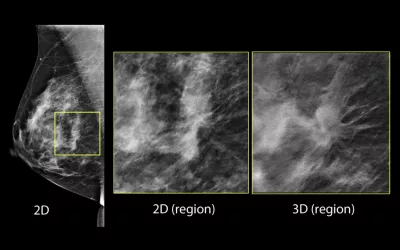 A comparison between 2D full-field digital mammography (FFDM), which has been the standard of care for years, and 3D mammography on the Hologic Selenia Dimensions Mammography System. 3D tomosynthesis shoots a series of images of the breast can can be flipped through as slices of specific layers of the breast tissue, where 2D shows all the breast tissue in one image. Dense breast tissue can hide cancers, as can be seen here where one of the 3D slices found a cancer masked by dense tissue on the 2D image. 