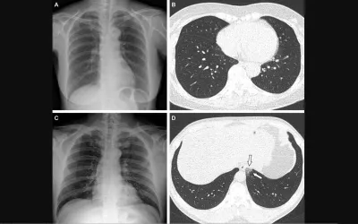 Representative cases showing pneumonia extents and patterns on chest X-ray (CXR) and CT images in COVID vaccinated breakthrough case showing lower COVID burden than unvaccinated. A 65-year-old female with breakthrough infection 2 months after a second dose of the Pfizer vaccine. Axial chest CT image at the lower lobe level (obtained on the same day) showing negatively for pneumonia; CT extent of pneumonia was scored as 0. RSNA Image. COVID on X-ray, CT scan. What does COVID look like in medical imaging?