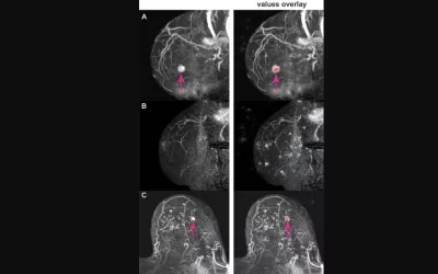 Examples of artificial intelligence (AI) deep Shapley additive explanations (SHAP) overlay on breast MRI. Maximum intensity projection (MIP) images are on left, and MIP images with the SHAP overlay are on right. Positive SHAP values (red) show areas that contribute to a high probability of lesion presence, negative SHAP values (blue) show locations with reduced probability. RSNA image