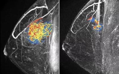Sagittal breast MRI showing computer-aided volumetry images of a 31-year-old woman with an invasive ductal carcinoma. Two images show a partial response to chemotherapy. The colored computer-aided volumetry images show 94% volume reduction, from 26.5 cm3 to 1.6 cm3. RSNA Image What does breast MRI look like? Breast imaging photos