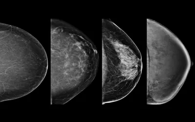 Example of the four types of breast tissue density. The density of fibroglandular tissue inside the breast impacts the ability to easily see cancers. Cancers are very easy to spot in fatty breasts, but are almost impossible to find in extremely dense breasts. These examples show craniocaudal mammogram findings characterized as almost entirely fatty (far left), scattered areas of fibroglandular density (second from left), heterogeneously dense (second from right), and extremely dense (far right). RSNA