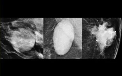 The shape of a breast mass carries can help deterine if it is cancer. Digital zoom mammographic projection images show, from left to right, round, oval, and irregular masses. An irregular mass has a higher probability of malignancy. Image courtesy of RSNA. Shape of breast lumps can determine if they are malignant. Examples of mammogram imaging.